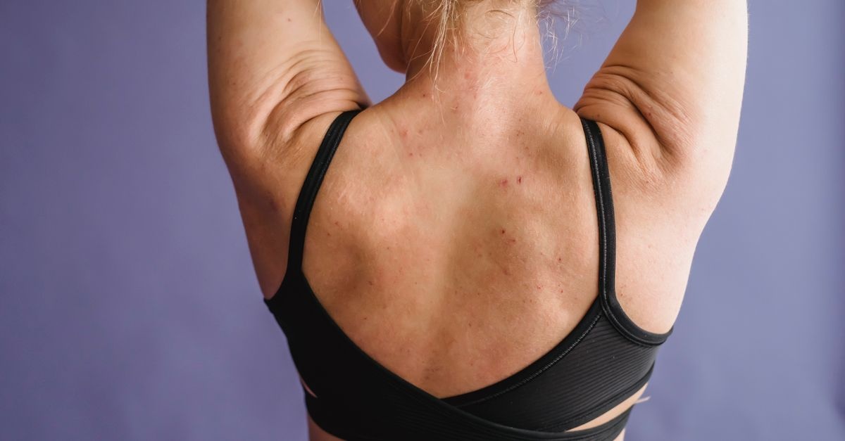 Adieu les boutons sur le corps : solutions efficaces pour une peau nette