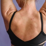 Adieu les boutons sur le corps : solutions efficaces pour une peau nette